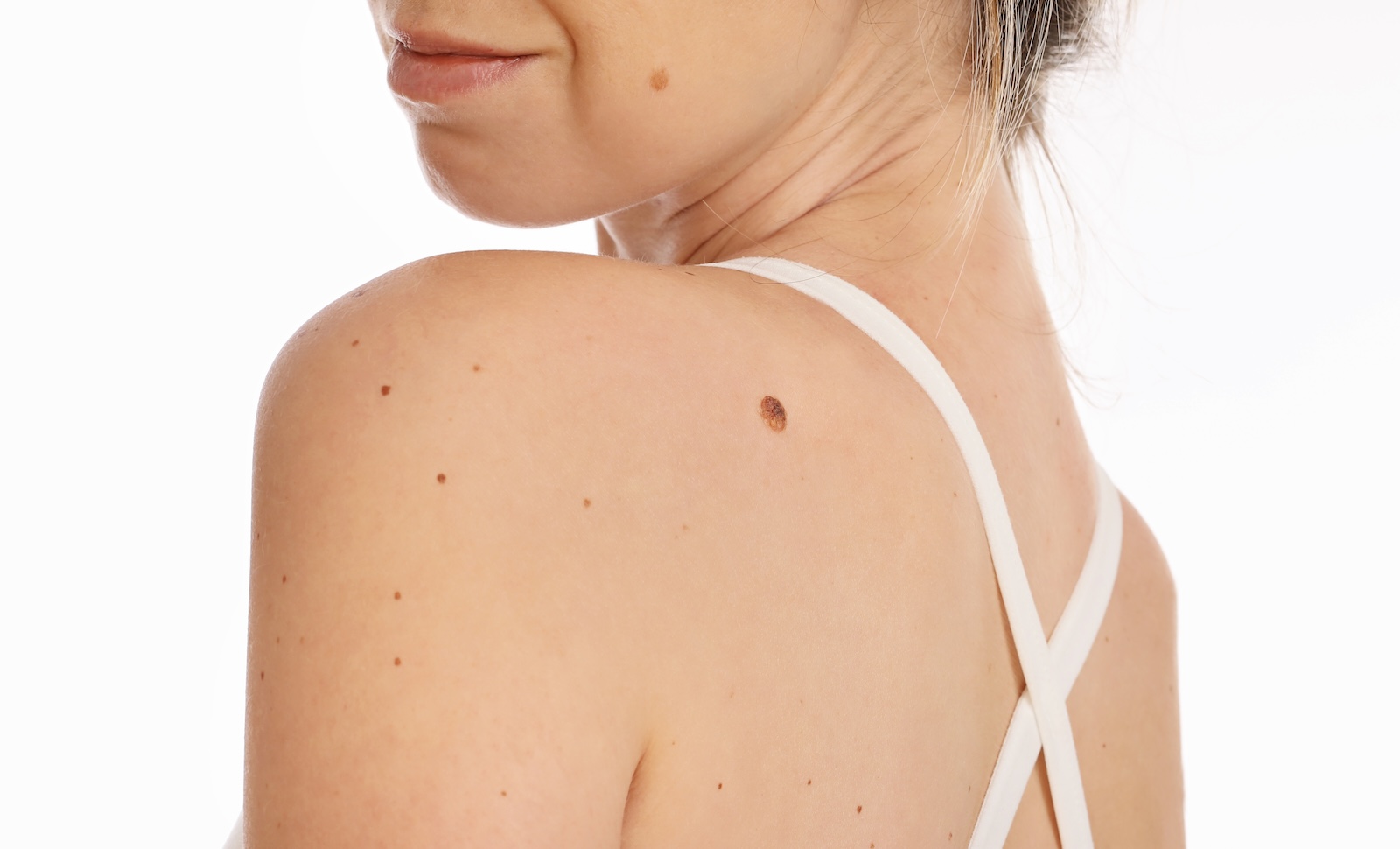 Dermatology consult
